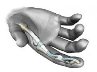 Почему болят суставы пальцев рук